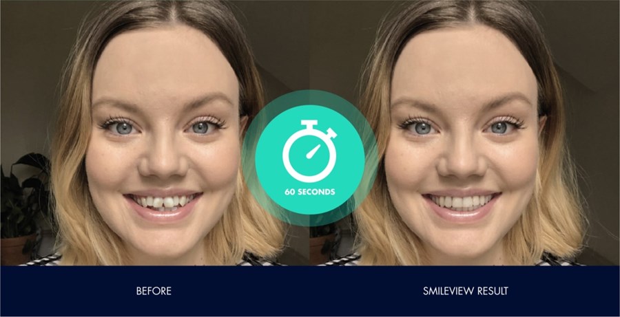 Invisalign - Before and after image